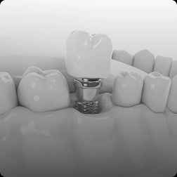 디지털 임플란트